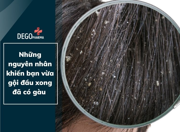 Những nguyên nhân khiến bạn vừa gội đầu xong đã có gầu
