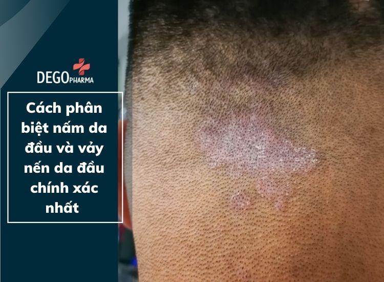 Cách phân biệt nấm da đầu và vảy nến da đầu chính xác nhất