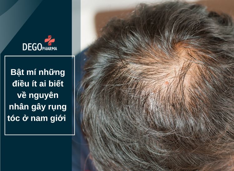 Bật mí những điều ít ai biết về nguyên nhân gây rụng tóc ở nam giới