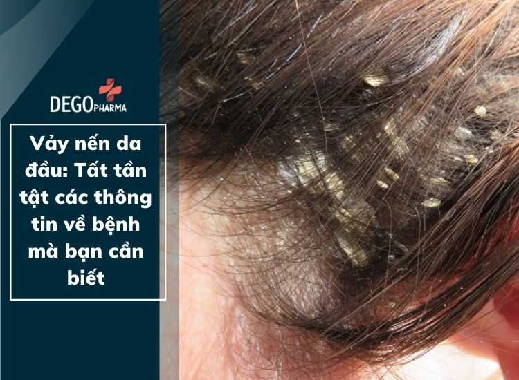 Vảy nến da đầu: Tất tần tật các thông tin về bệnh mà bạn cần biết