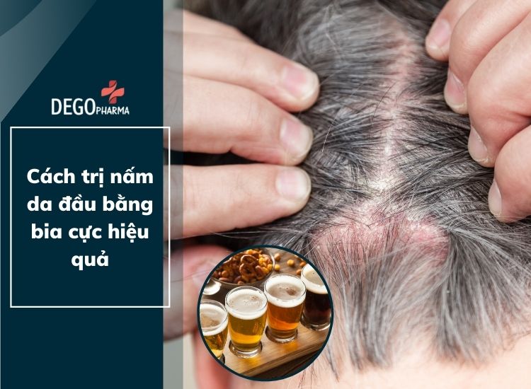 Cách trị nấm da đầu bằng bia