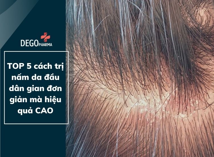 TOP 5 cách trị nấm da đầu dân gian đơn giản mà hiệu quả CAO