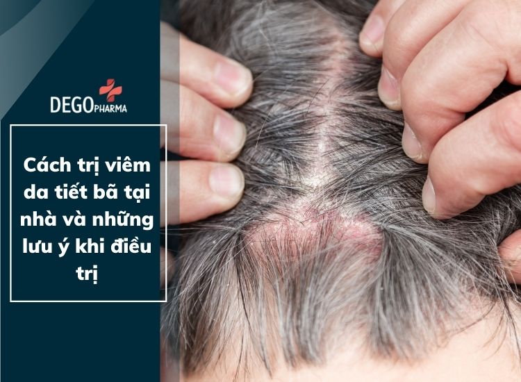 Cách trị viêm da tiết bã tại nhà và những chú ý khi điều trị