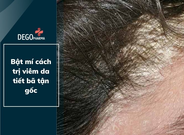 Bật mí cách trị viêm da tiết bã tận gốc