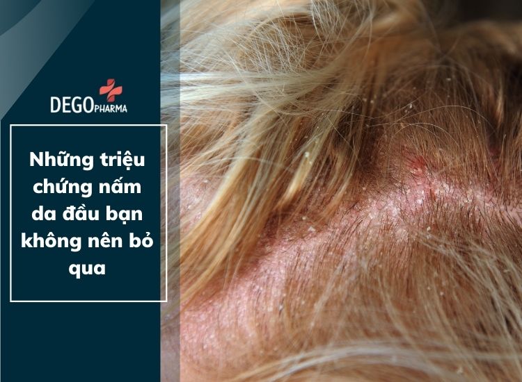 Những triệu chứng nấm da đầu bạn không nên bỏ qua