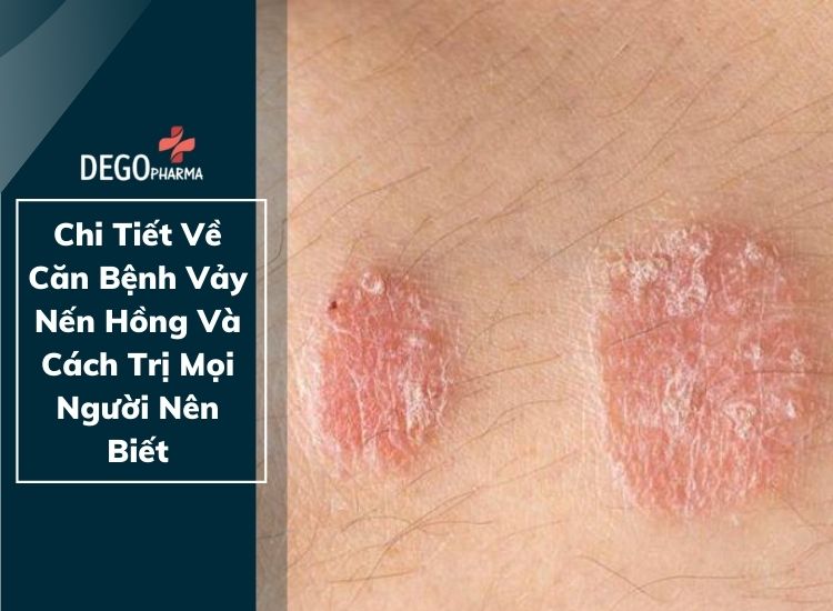 Chi Tiết Về Căn Bệnh Vảy Nến Hồng Và Cách Trị Mọi Người Nên Biết