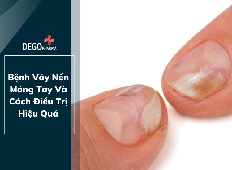 Bệnh Vảy Nến Móng Tay Và Cách Điều Trị Hiệu Quả