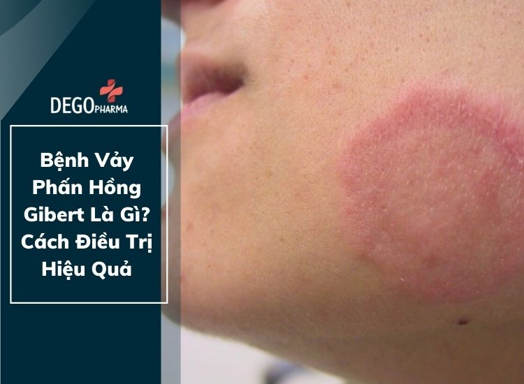 Bệnh Vảy Phấn Hồng Gibert Là Gì? Cách Điều Trị Hiệu Quả