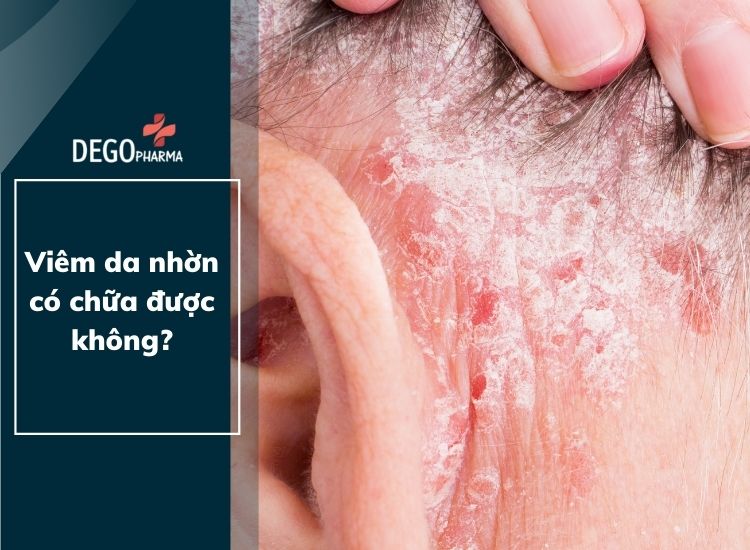 Viêm da tiết bã nhờn có chữa được không?