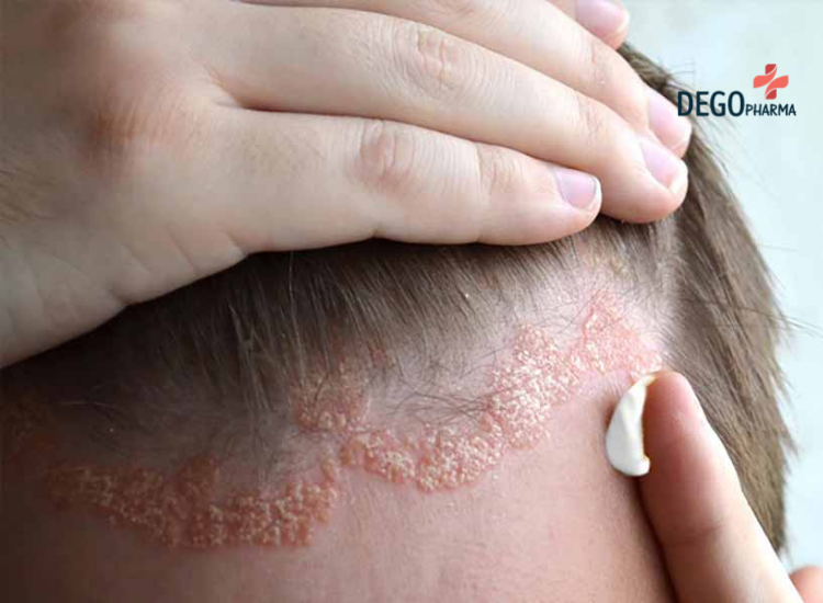 viêm da dầu có chữa được không