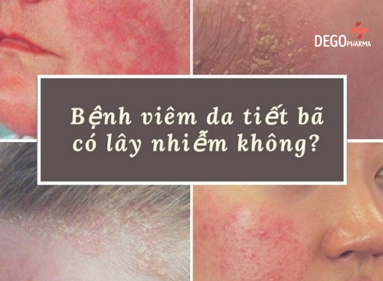 viêm da dầu nên kiêng gì
