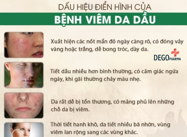 dấu hiệu viêm da đầu