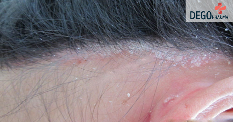 cách trị nấm da đầu