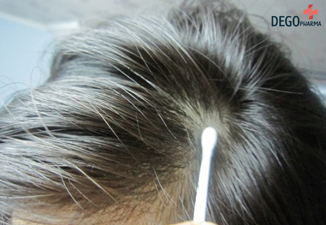 phác đồ điều trị nấm da đầu
