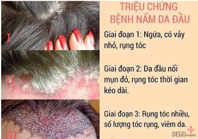 cách điều trị nấm da đầu