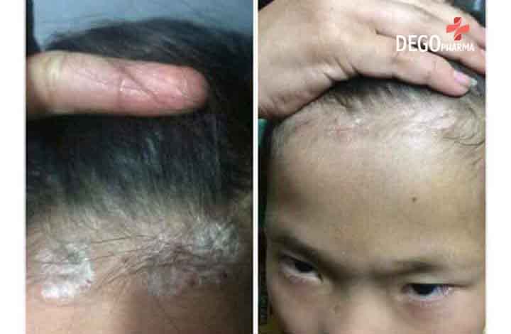 Nấm đầu
