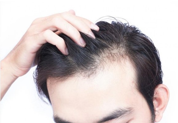 Rụng tóc ở nam ɡiới: Những dấu hiệu đáng chú ý và cách điều trị 