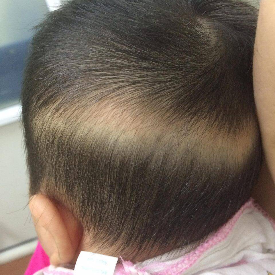 Phòng ngừa rụng tóc vành khăn 