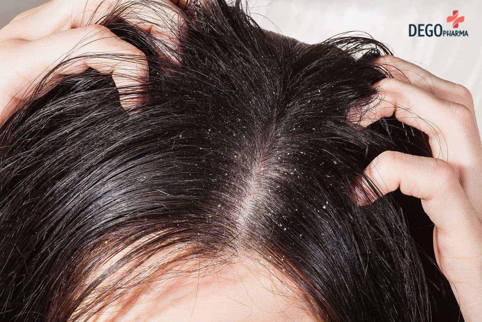 da đầu bị gầu