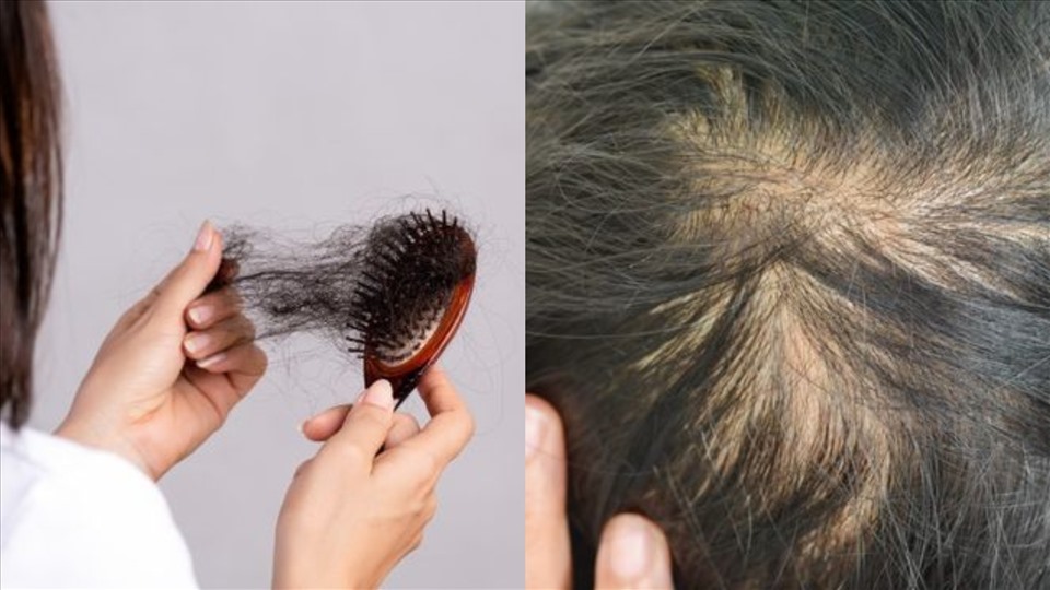 Rụng tóc ở nam ɡiới: Những dấu hiệu đáng chú ý và cách điều trị 