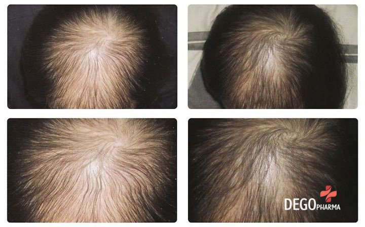 Trị rụng tóc 