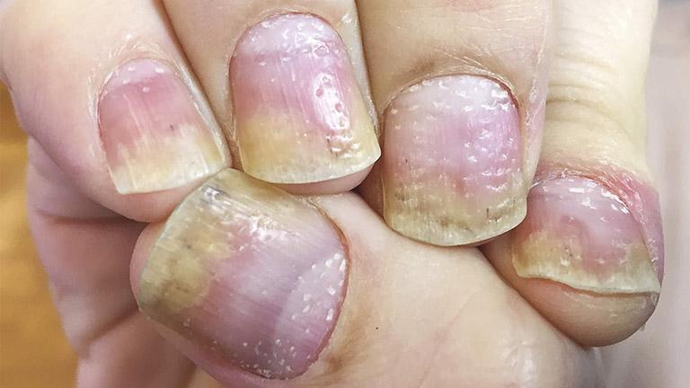 Thế nào là bệnh vẩy nến móng tay?
