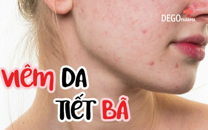 điều trị viêm da tiết bã 