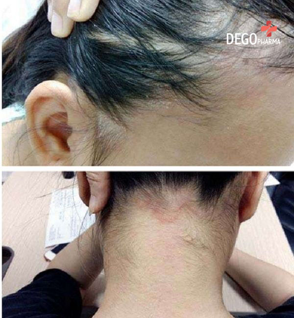 chữa bệnh viêm da tiết bã 
