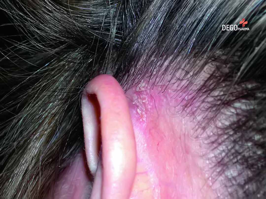 Thuốc trị viêm da tiết bã ở mặt