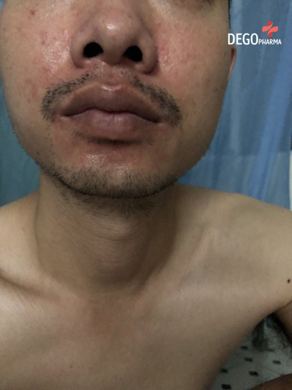 chữa bệnh viêm da tiết bã 