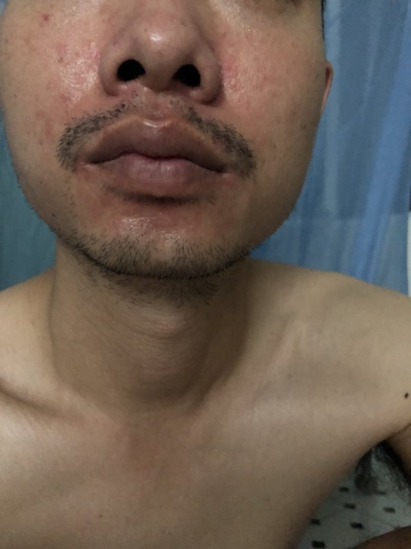 Bệnh viêm da tiết bã nhờn có triệu chứng nguy hiểm gì không?