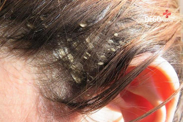Chữa viêm da tiết bã da đầu ngay tại nhà đơn giản