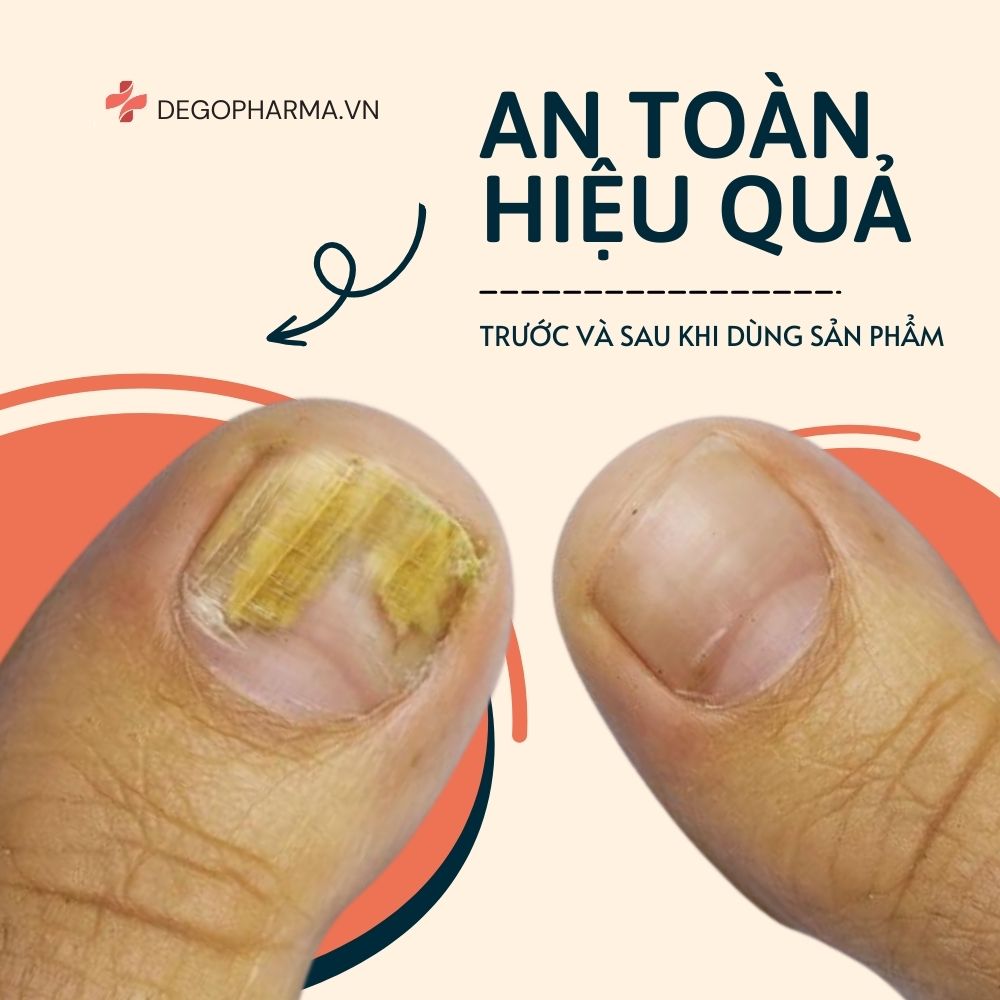 Lưu ý khi sử dụng thuốc trị nấm móng tay Dego Pharma