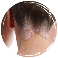 VẢY NẾN LÂU NĂM