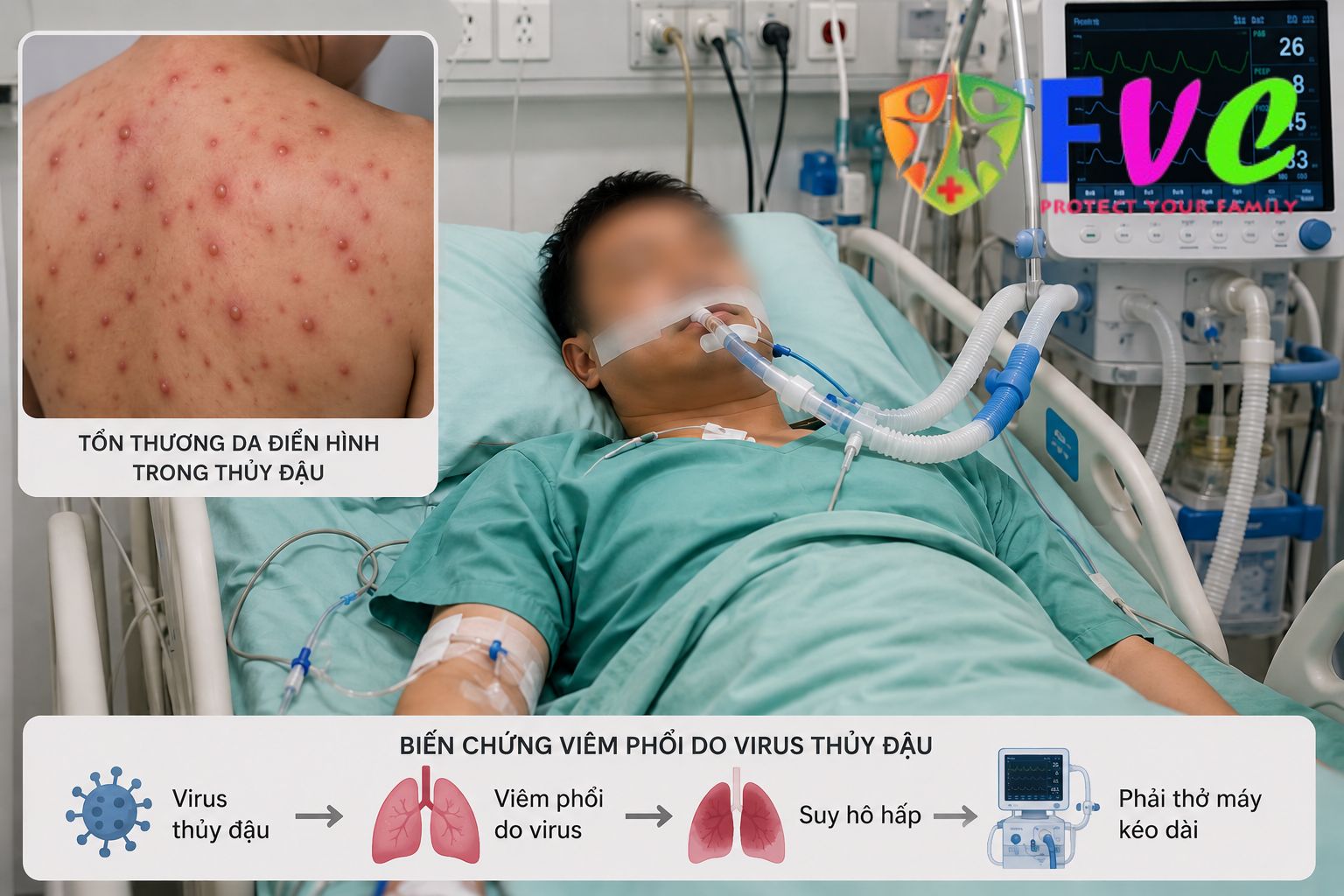 Nam bệnh nhân 32 tuổi bị biến chứng thuỷ đậu phải thở máy kéo dài