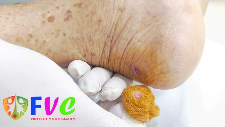 Vết thương nhỏ do gà mổ, nguy cơ lớn nếu không xử trí đúng cách
