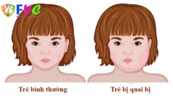 Chớ bỏ qua 5 biến chứng nguy hiểm từ bệnh quai bị