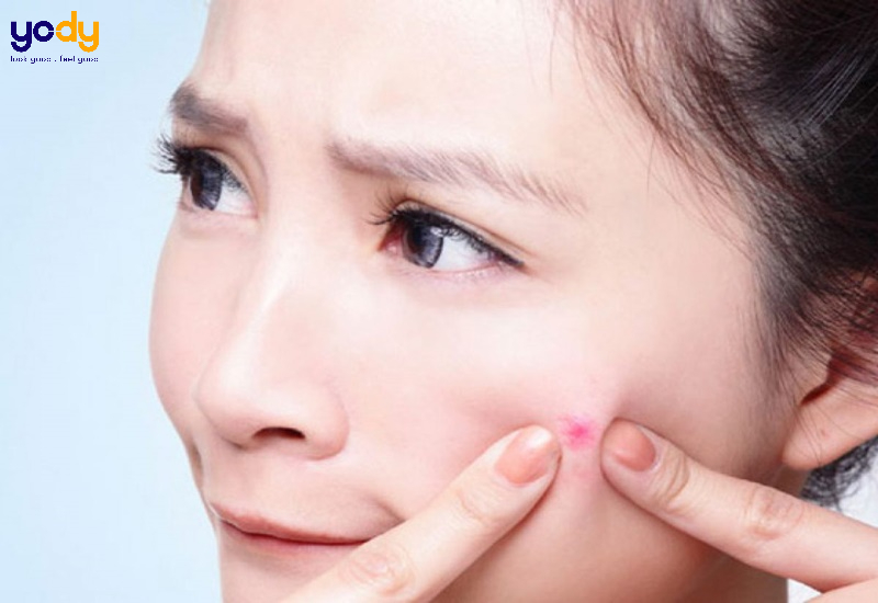 Nặn mụn xong nên làm gì?
