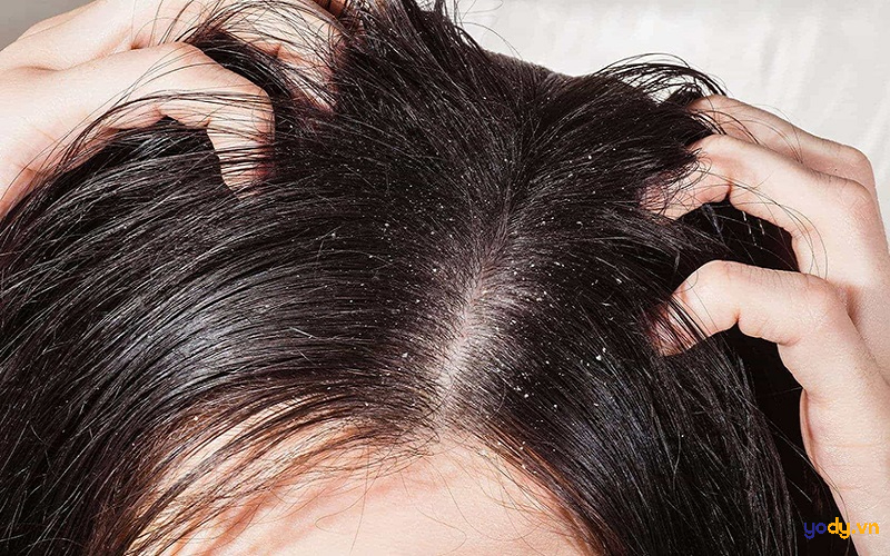 Dầu gội trị gàu