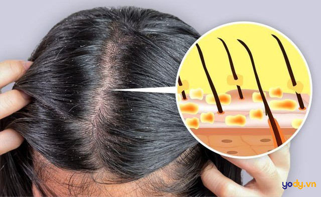 Dầu gội trị gàu
