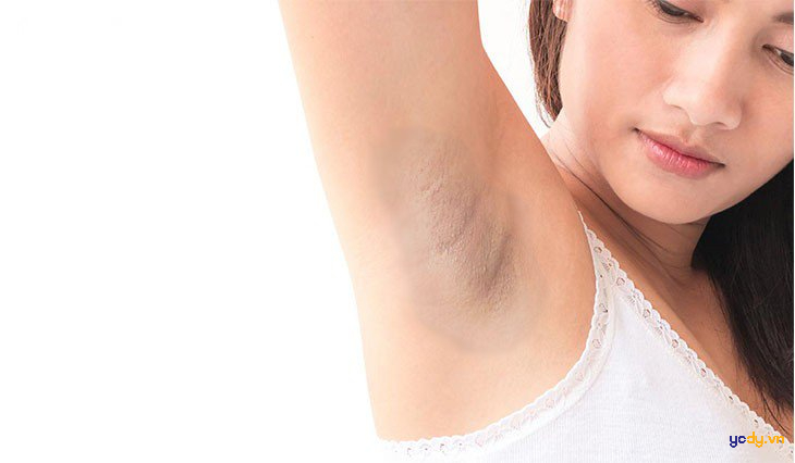 Kem trị thâm nách Nhật Bản