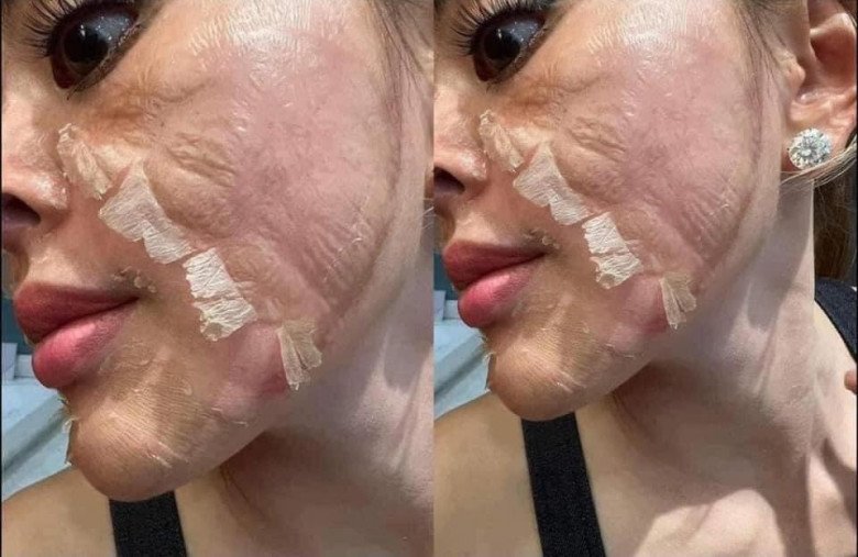 Peel da là gì? Có nên peel da tại nhà?