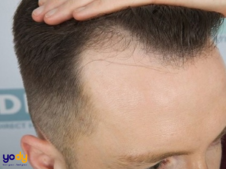 Trán cao để tóc gì nam? Thử 7+ kiểu tóc nam che khuyết điểm
