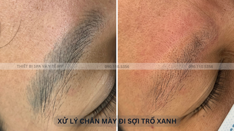 bắn laser xử lý chân mày đi sợi
