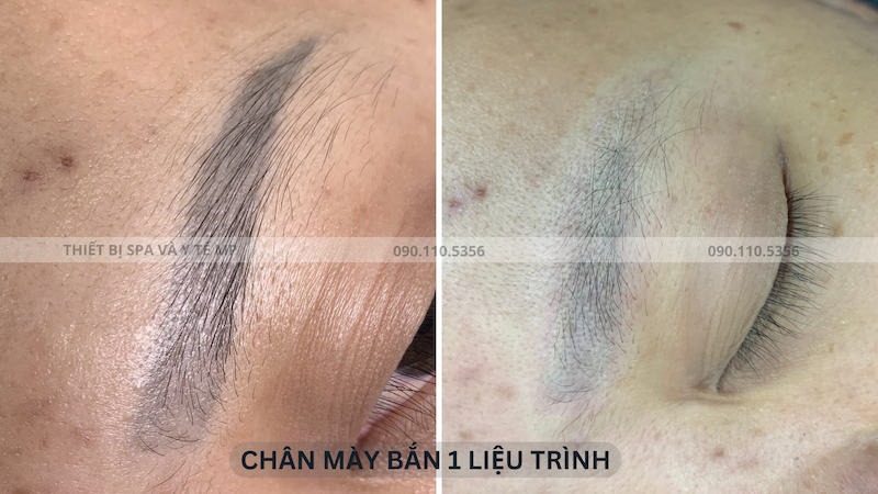 Xoá xăm lông mày