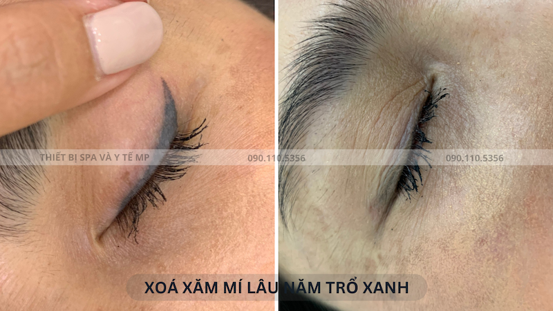 bắn laser xoá xăm mí