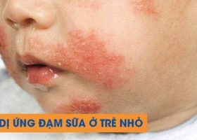 TRẺ BỊ DỊ ỨNG ĐẠM SỮA BÒ NÊN DÙNG SỮA NÀO THAY THẾ?