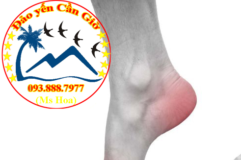 Bệnh gút ăn yến được không? Cách sử dụng yến sào cho người bị gút