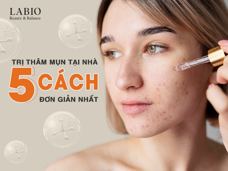 5 Cách Trị Thâm Mụn Tại Nhà Đơn Giản Nhất