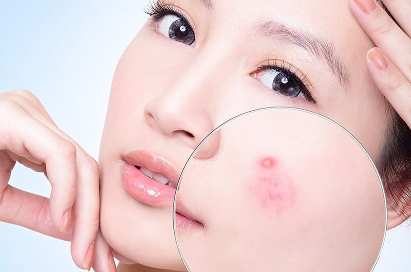 Serum cho da dầu mụn có tác dụng gì?